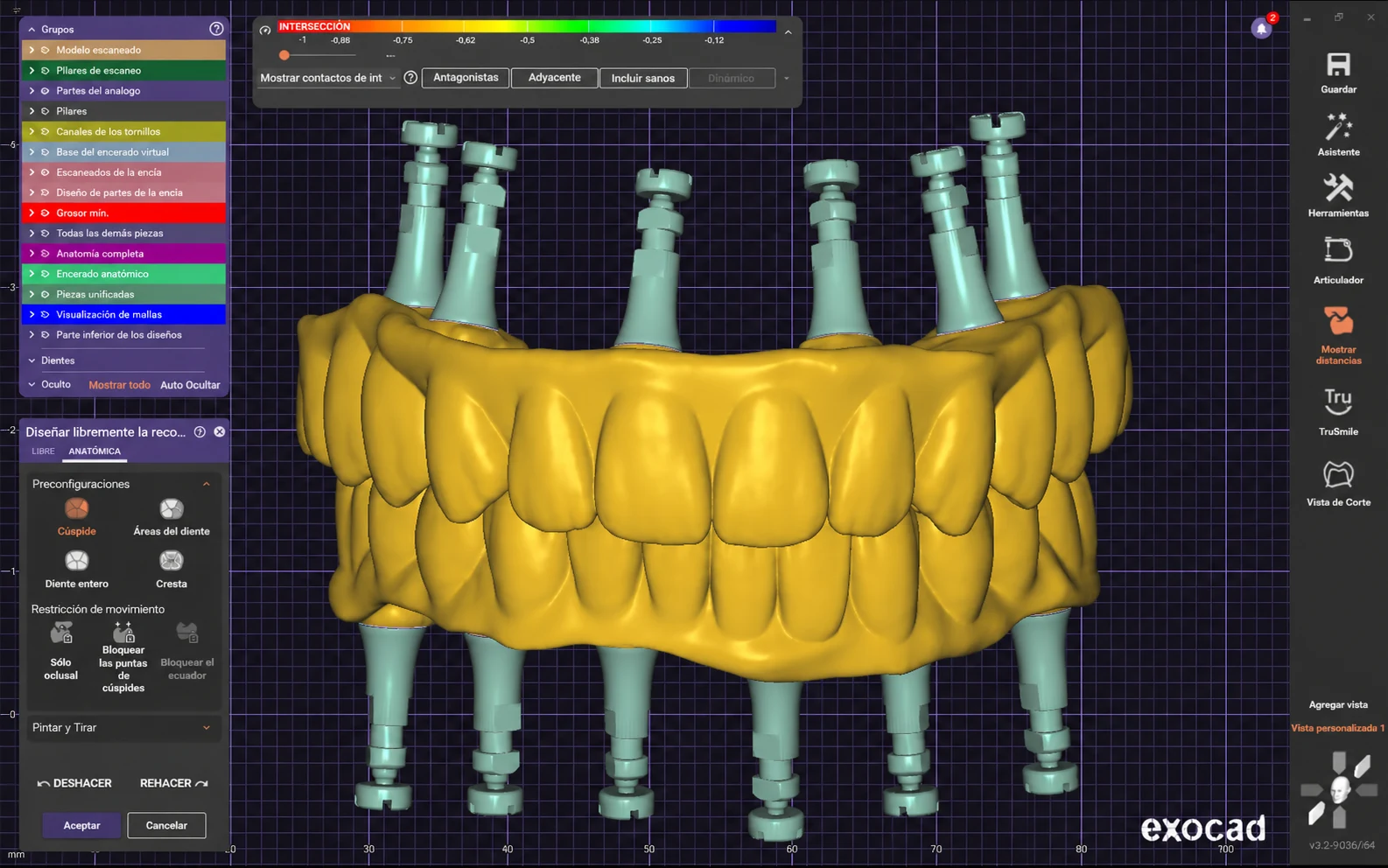 Planificación digital CAD en exocad en laboratorio dental Digitalis en Málaga