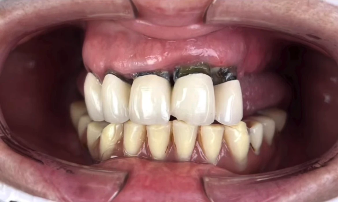 Estado inicial severo de desajuste protésico y filtración gingival antes de rehabilitación bimaxilar