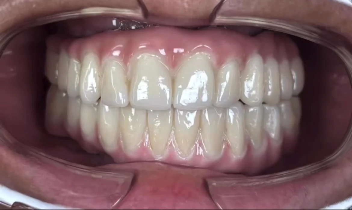 Resultado prótesis híbrida superior e inferior en circonio sobre implantes barra tipo Blender Málaga